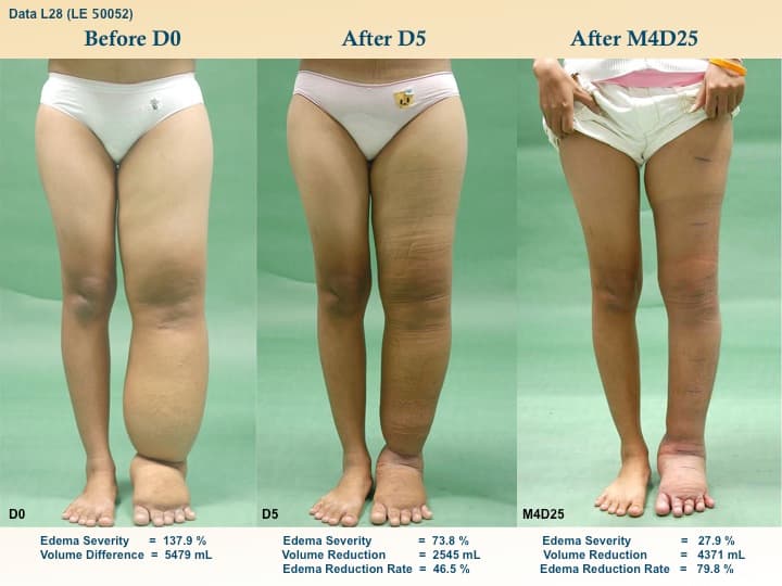 legswell1