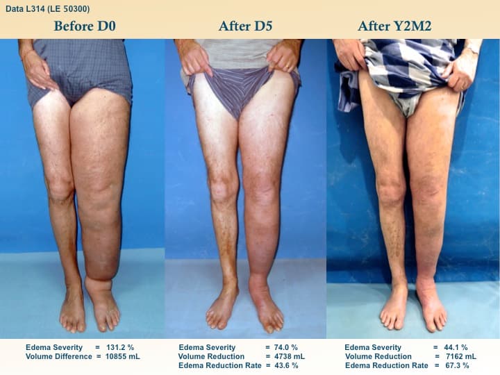 legswell10