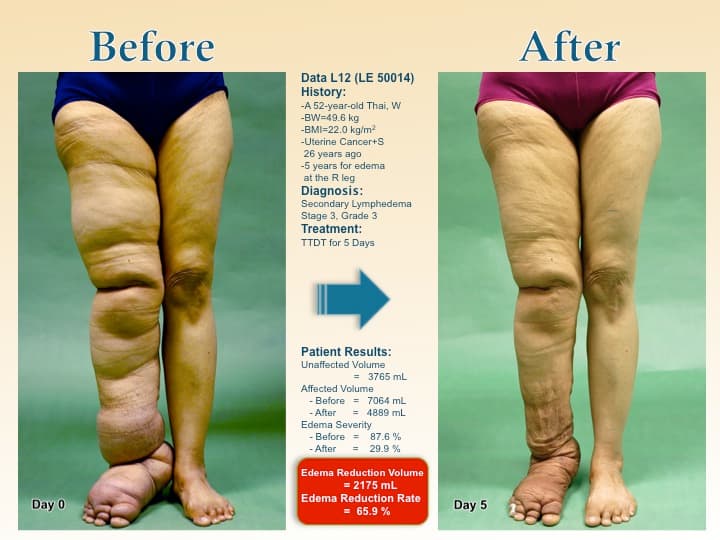 legswell14