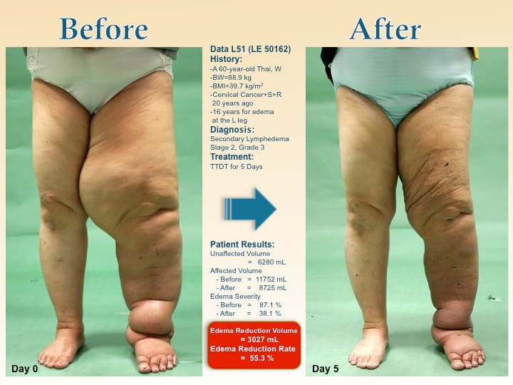legswell15