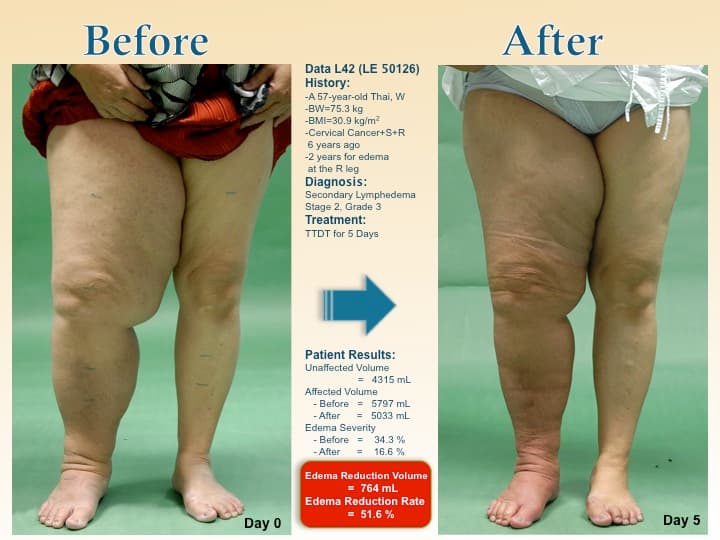 legswell16