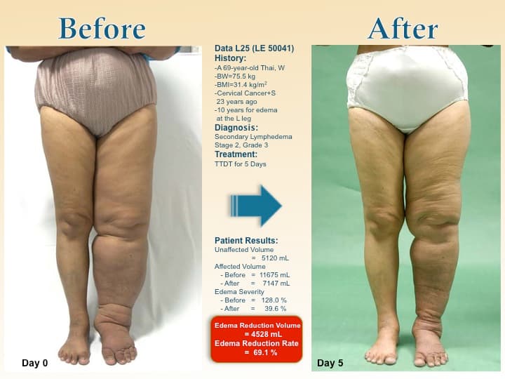 legswell18