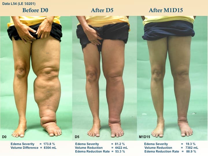 legswell2