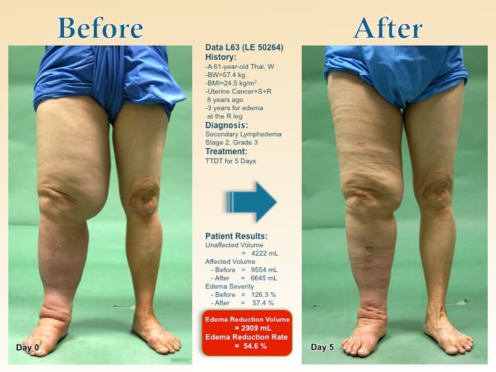 legswell20