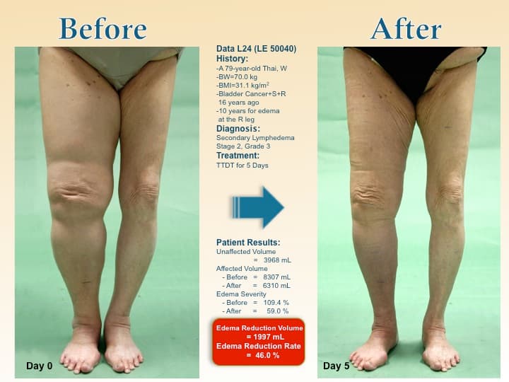legswell22