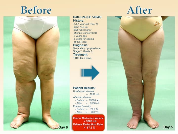 legswell25