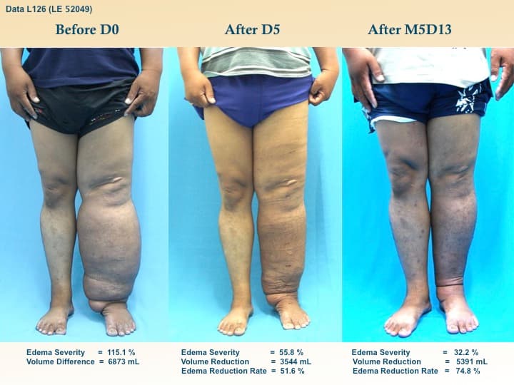 legswell3