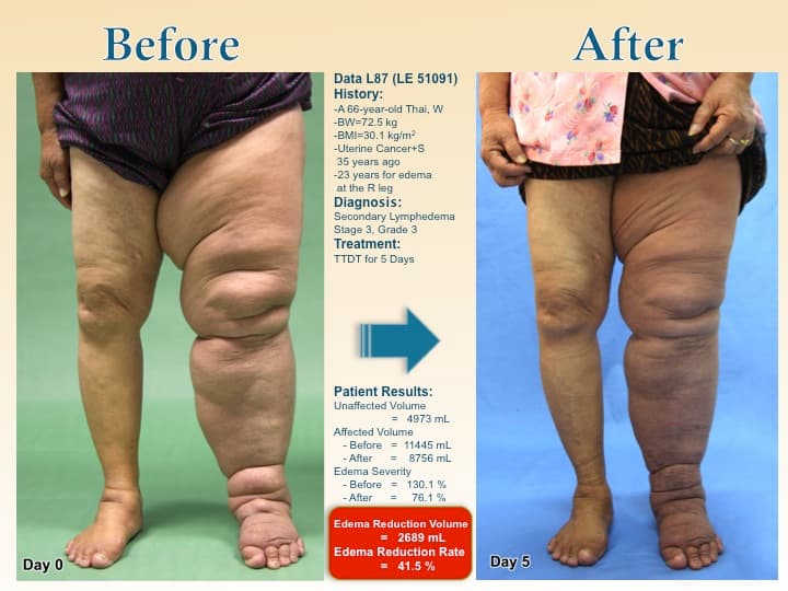 legswell30