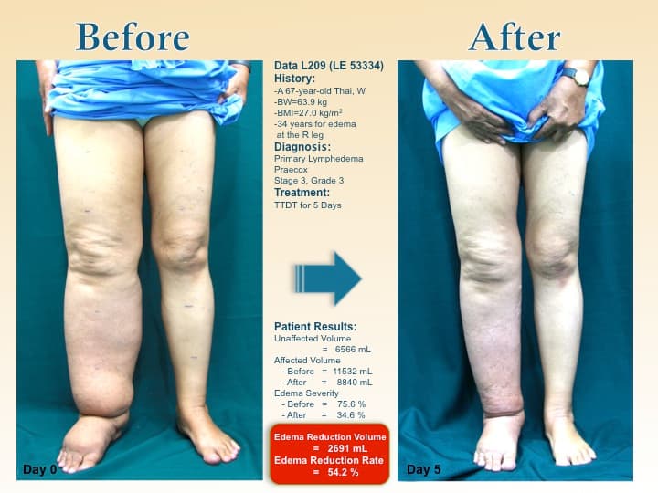 legswell35