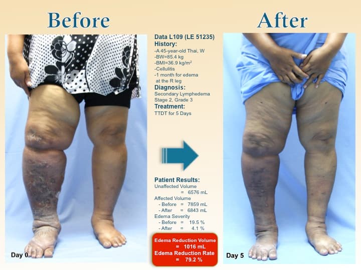 legswell38