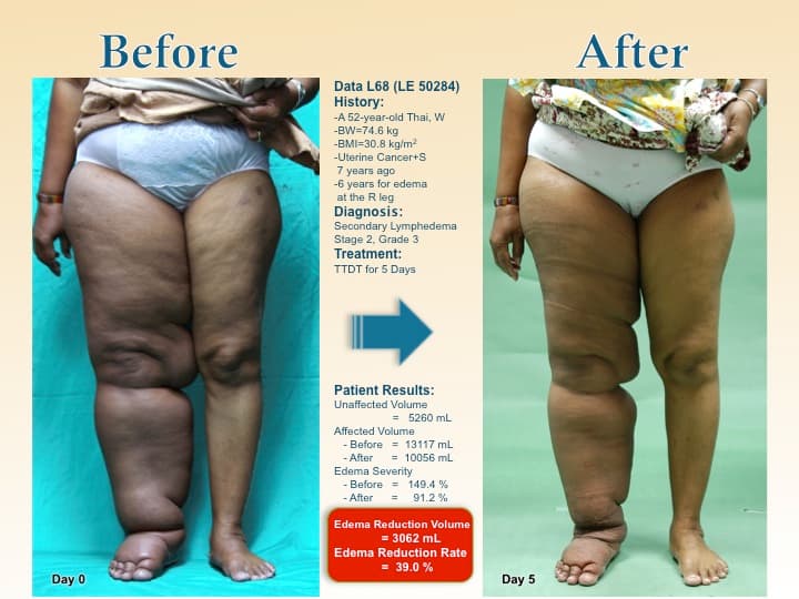 legswell41