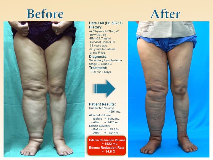 legswell43