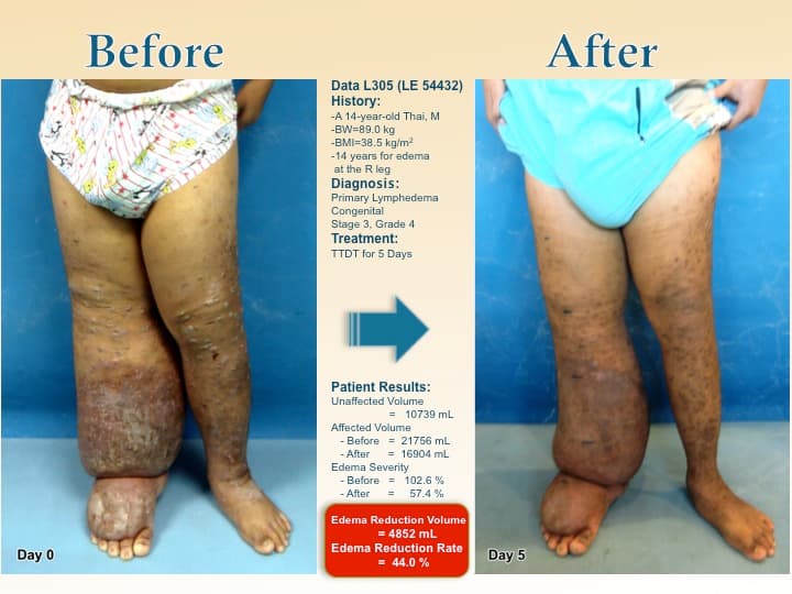 legswell45