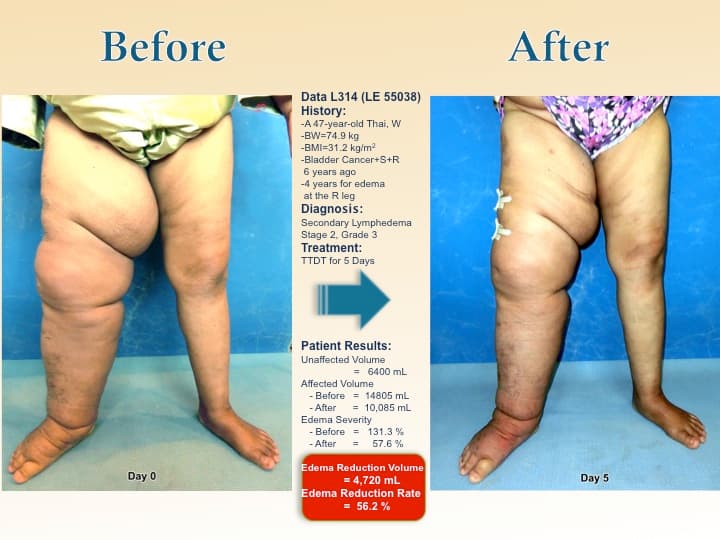 legswell48