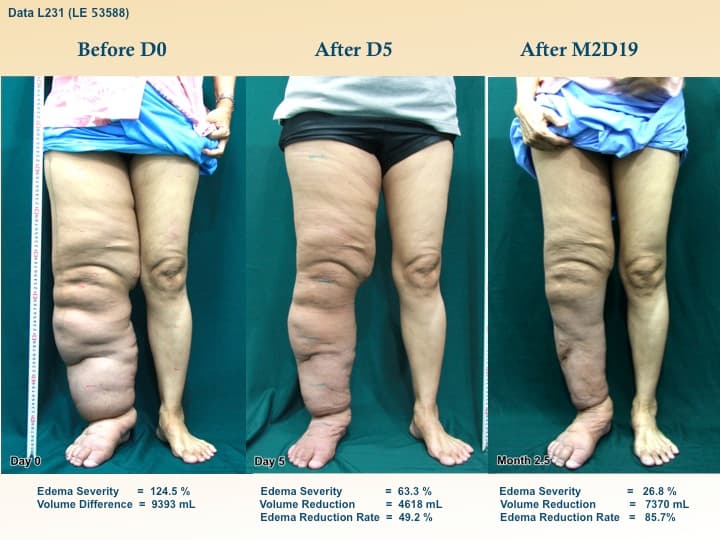 legswell5