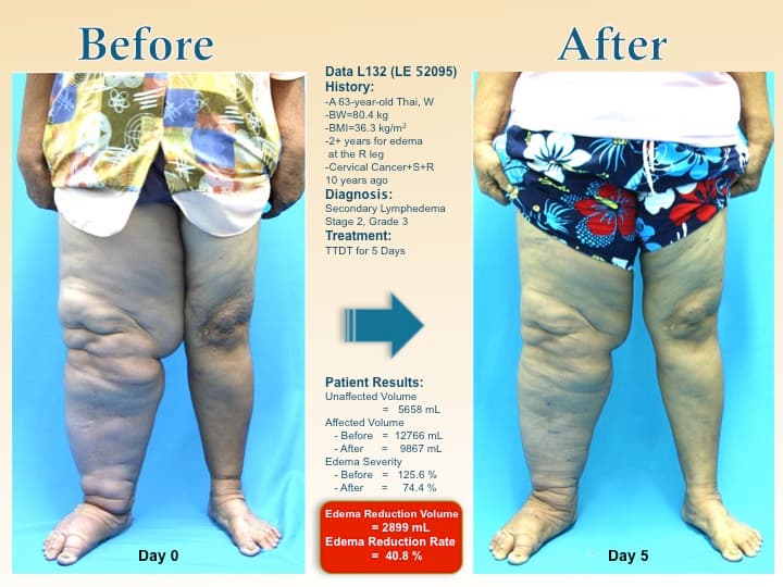 legswell50