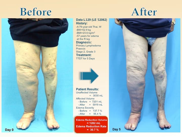 legswell53