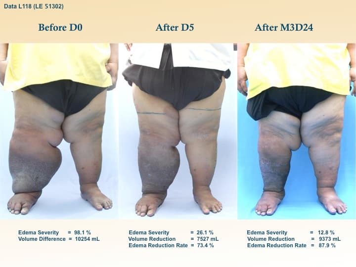 legswell6