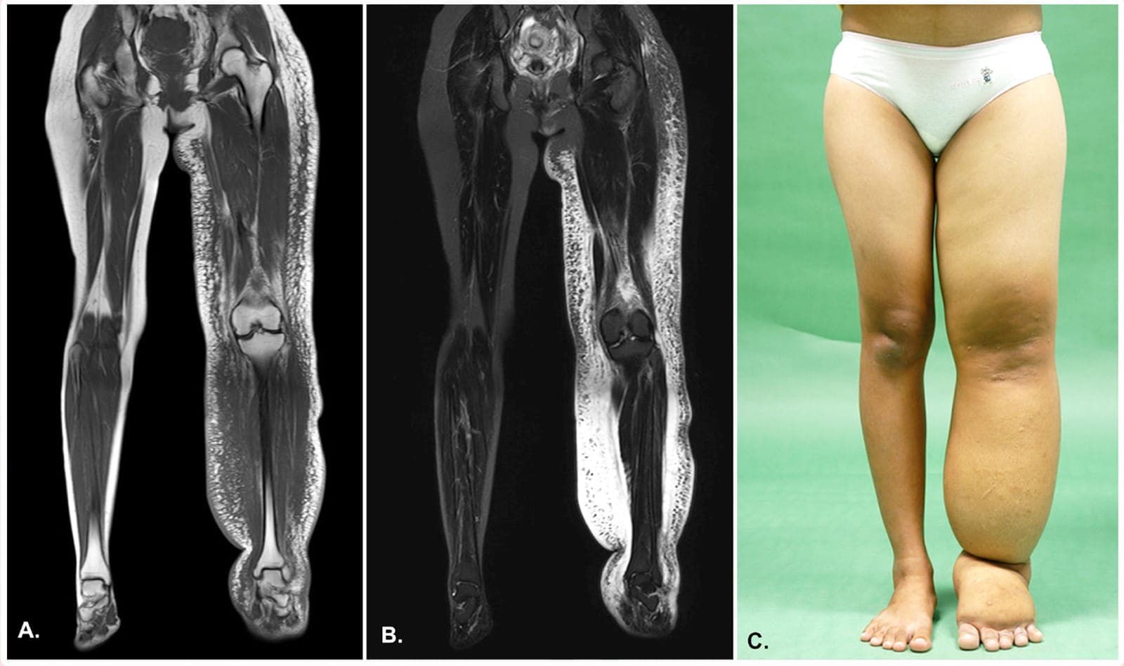lymph x-ray