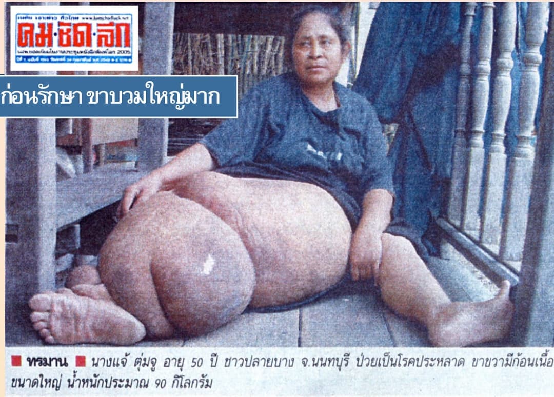 ภาพผู้ป่วยตัวอย่าง 1